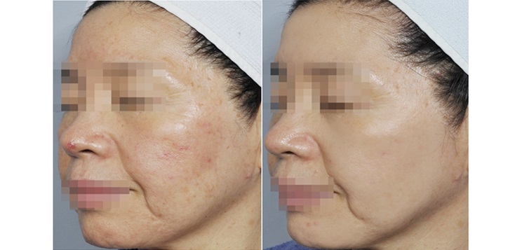 kết-quả-điều-trị-sylfirm-4