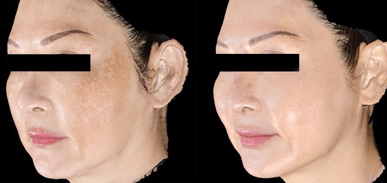 kết-quả-điều-trị-sylfirm-5