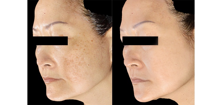 kết-quả-điều-trị-sylfirm-6