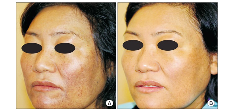 kết-quả-điều-trị-sylfirm-1
