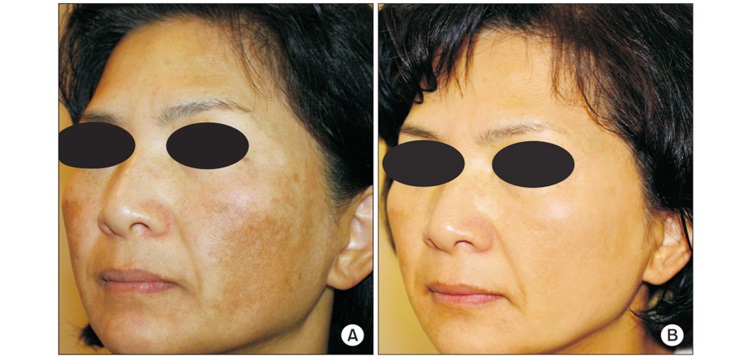kết-quả-điều-trị-sylfirm-2