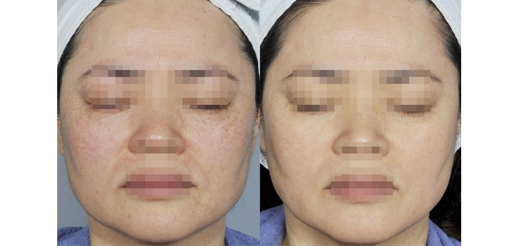 kết-quả-điều-trị-sylfirm-3